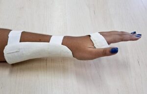 Projeto da UFRN oferece órteses gratuitas e personalizadas para pacientes com alterações musculoesqueléticas